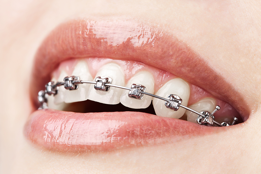 Transform Your Smile with Braces in Alton, Donna, and McAllen, TX: A Comprehensive Guide
