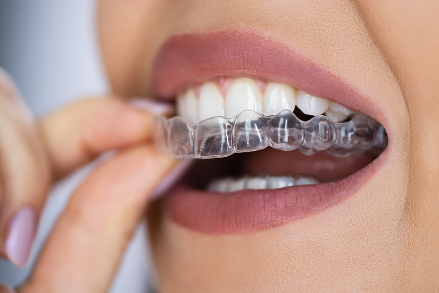 Transform Your Smile with Clear Aligners in Alton, Donna, and McAllen, TX