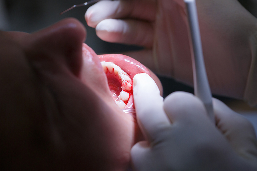 Effective Solutions for Periodontal Disease Therapy in Alton, Donna, and McAllen, TX